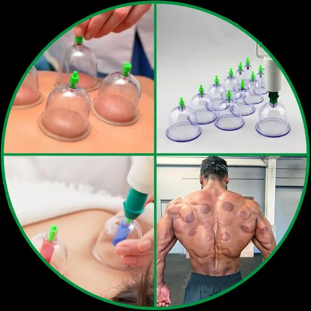 الحجامة النبوية ( داخل اسطنبول أوربا ) - مجموعة واتساب